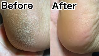 荒れ果てたカカトを3日間本気でケアしたら見違えるほどツルツルに・・・！