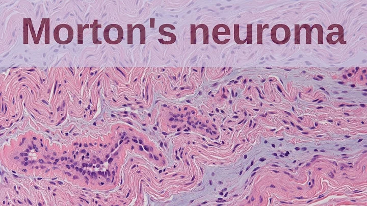 What is a Morton's Neuroma? - Pathology mini tutorial