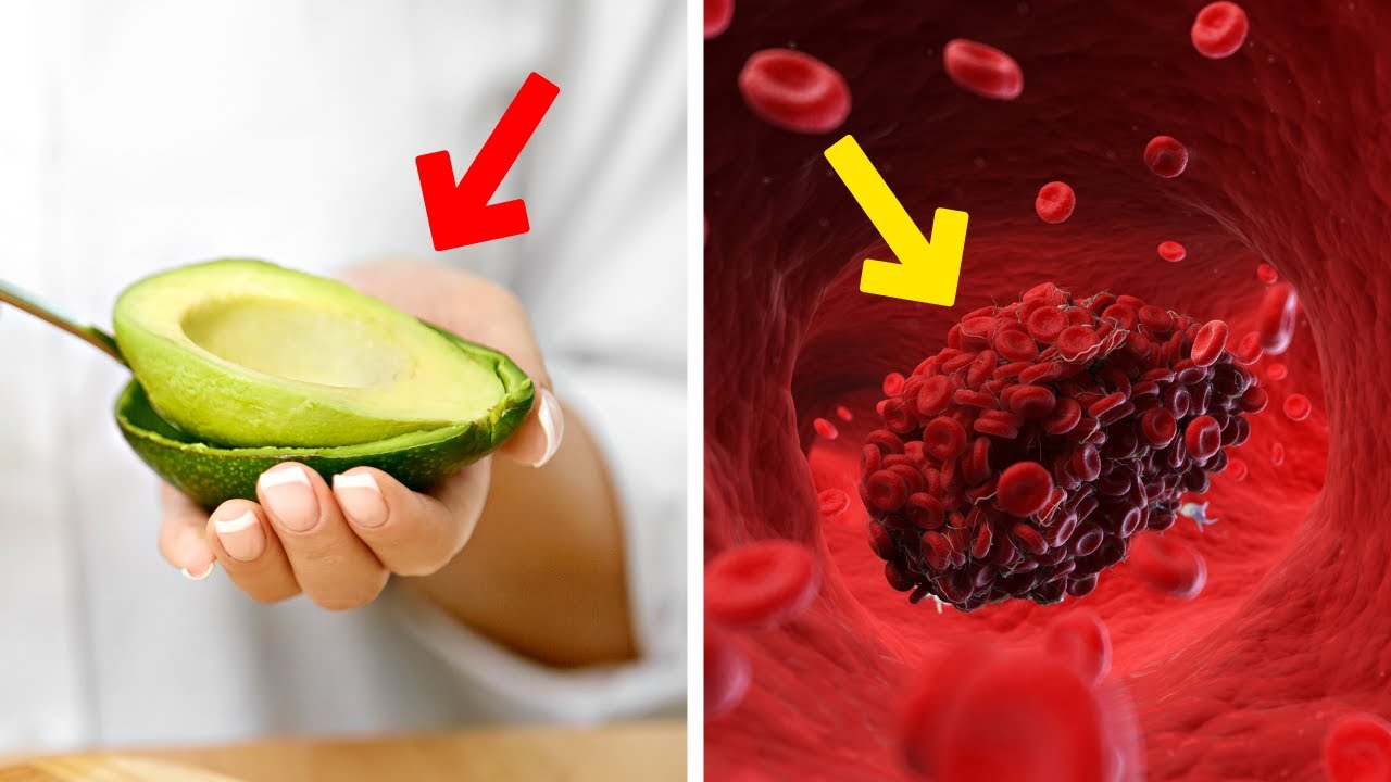 Eat These Foods To Prevent Blood Clots Heart Attacks And Strokes YouTube eat-these-foods-to-prevent-blood-clots-heart-attacks-and-strokes-youtube