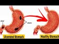 Stomach Ulcer - Causes And Natural Treatment | Dr. Vivek Joshi