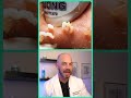 Derm reacts to pimple jackpot pimplepop dermreacts doctorreacts