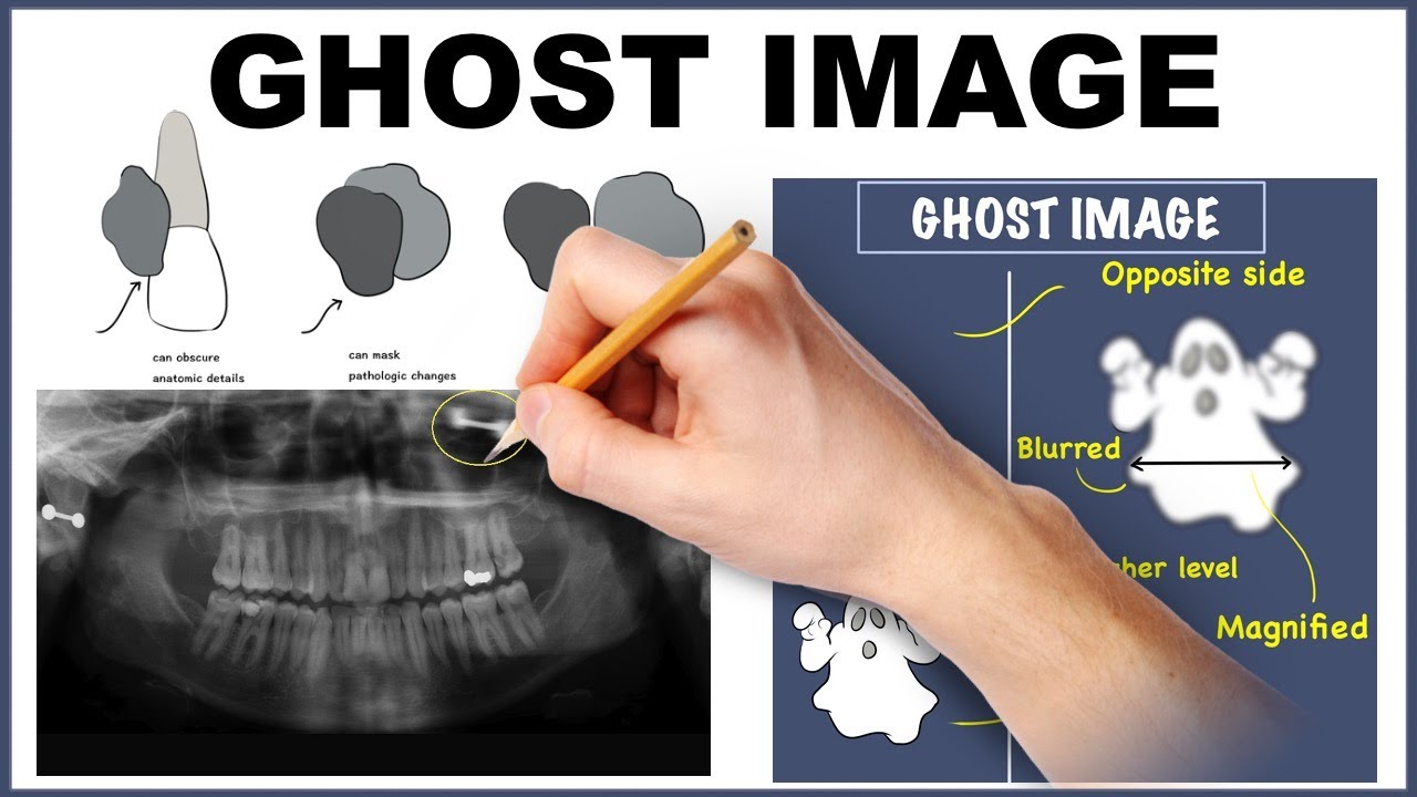 ghost image radiography