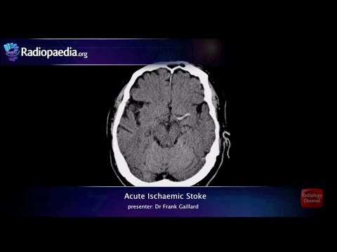 Stroke: Acute infarction - radiology video tutorial (CT, MRI, angiography)