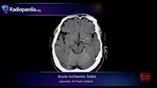 Stroke: Acute infarction - radiology video tutorial (CT, MRI, angiography) Resimi