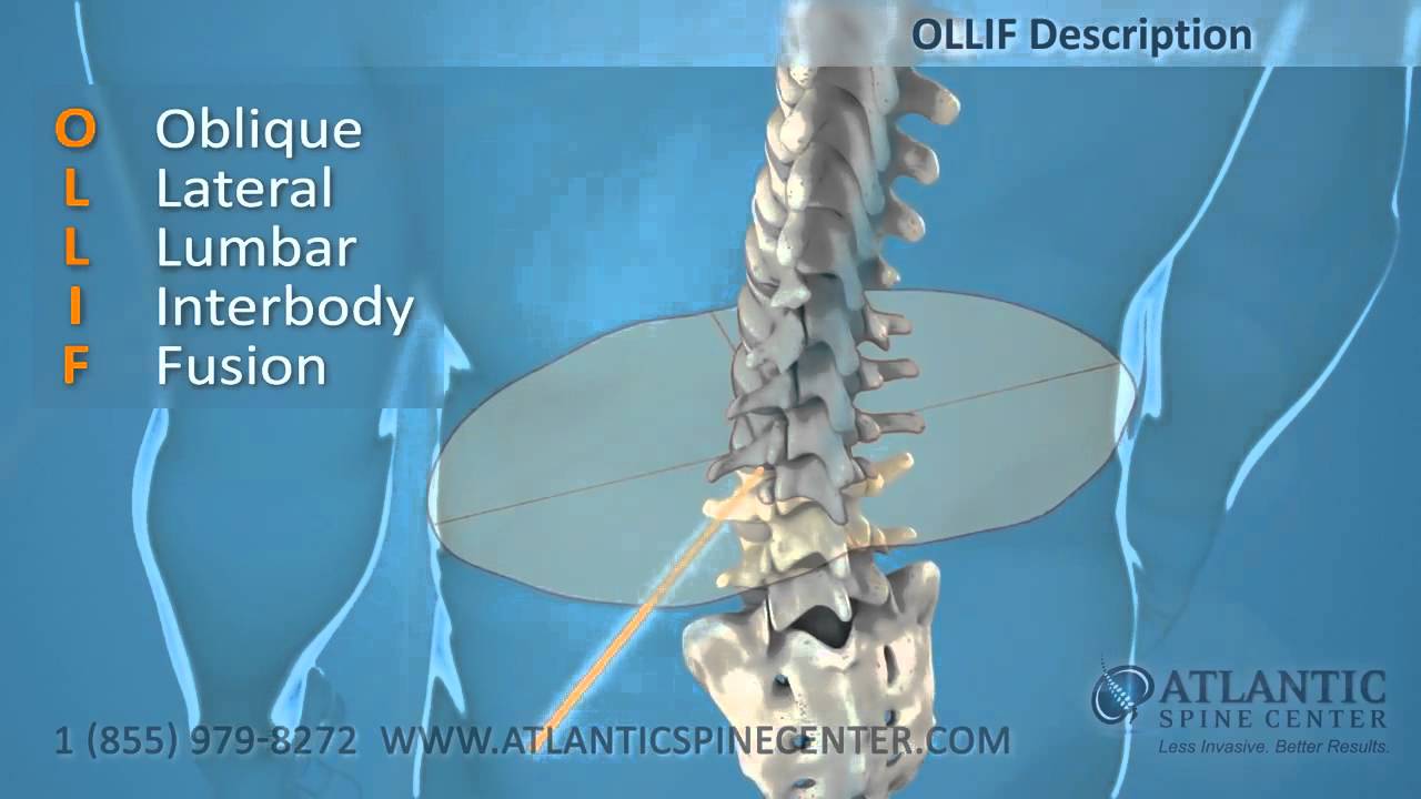 Xlif Lumbar Spinal Fusion