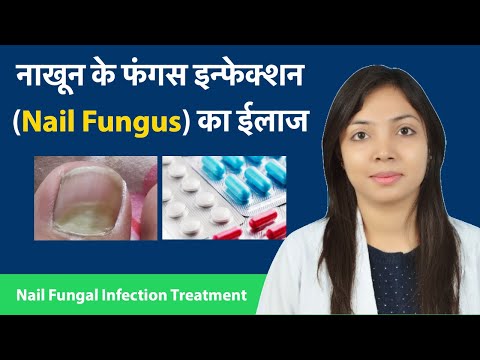 नाखून के फंगस इन्फेक्शन का ईलाज (हिंदी) | Nail Fungal infection symptoms, treatment and Medicines