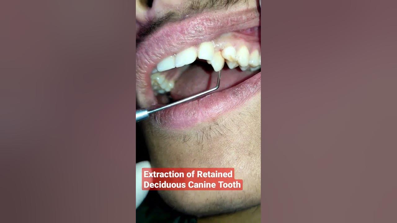  extraction of retained deciduous canine tooth delayed exfoliation