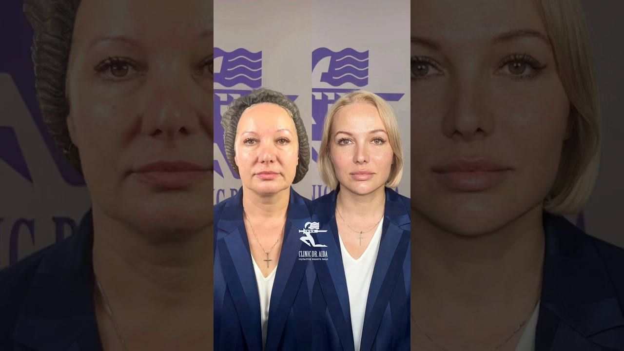 Full Face - омоложение за час!