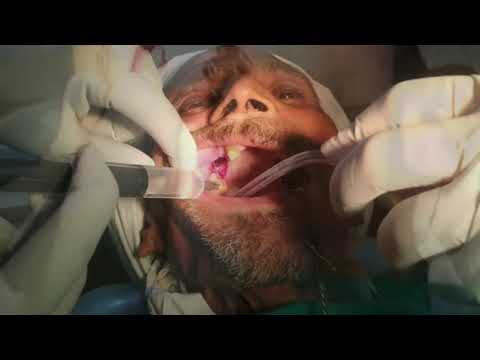 buccal fat pad||oroantral fistula treatment video||water from nose on drinking