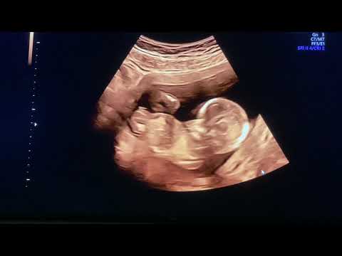 Video: 12 Uger Gravid - Ultralyd Og Fosterstørrelse, Babyens Køn, Hvad Sker Der?