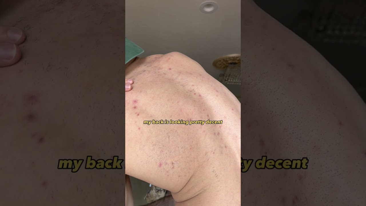 10 дней после лазерной эпиляции 