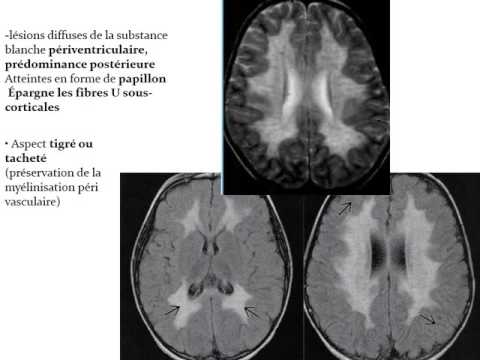 Vidéo: Le fond d'œil tigroïde est-il normal ?