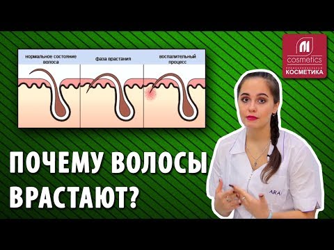 Почему волосы врастают? Профилактика вросших волос после шугаринга. Как избавиться от вросших волос?