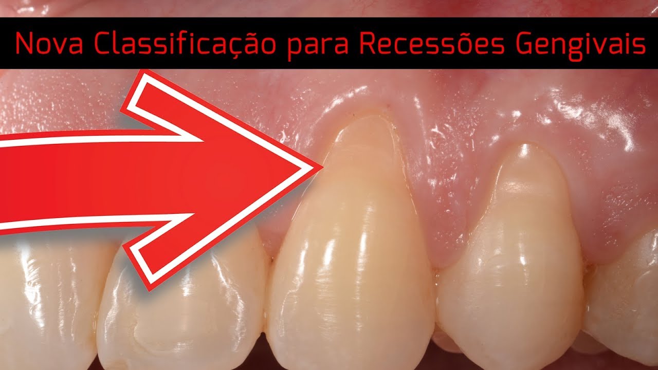 (Ep 10) Nova classificação de recessão gengival