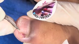 Ep_6551 Ingrown toenail removal 👣 ออกแล้ว..หนีกลับเข้าไปอีก 😄 (clip from Thailand)