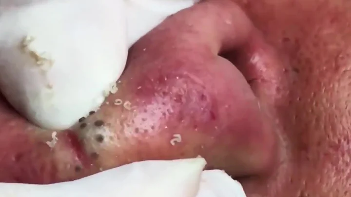 Blackheads extrations Bigblackheads Bigblackheadso...