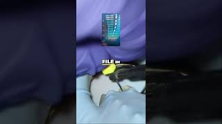 K File Palatal Procedure  Challenges & Tricks