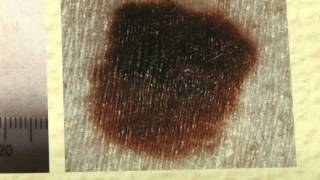 S.Africa Skin Cancer: Exposure to Sun Increases Cancer Risk