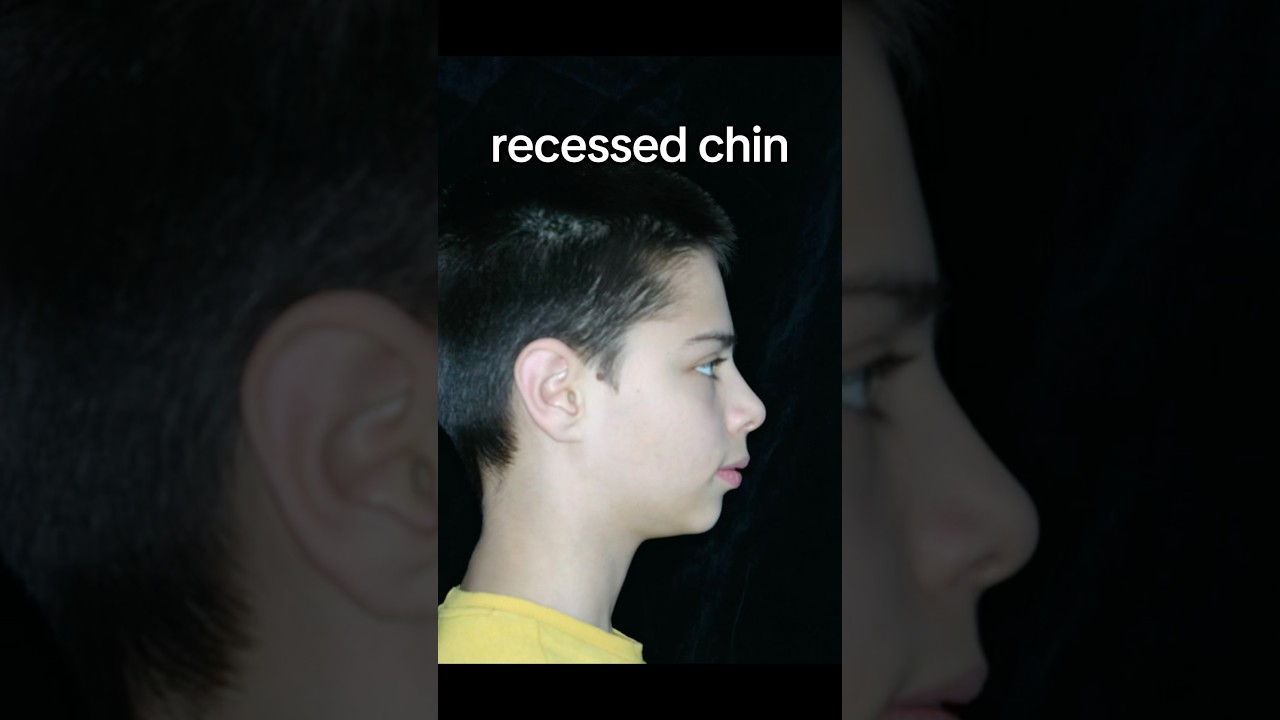 how to fix your recessed chin 