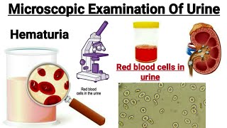 Microscopic examination of urine || Causes of Red blood cells in urine || Hematuria in hindi