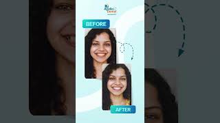 Before After Smile Transformation 😁 | Teeth Whitening in Nallakunta Hyderabad | Brighten Your Smile