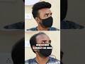 Hair patch service for men| Hair Patches for men