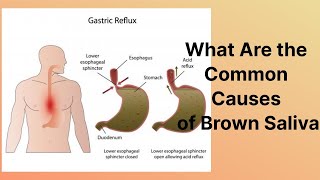 What Are the Common Causes of Brown Saliva