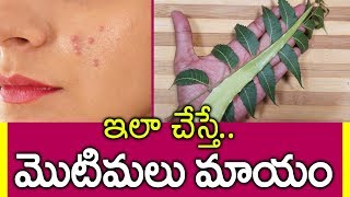 మొటిమలు వెంటనే తగ్గాలంటే? I Motimalu Thaggalante I Pimples Problem in telugu I Everything in Telugu