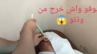 شموع الهوبي لعلاج مشاكل الاذن وتنظيفها من الاوساخ انظروا ماذا خرج من أذنه ? 0665979311/0795213705