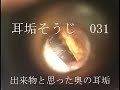 耳垢そうじ/出来物と思った鼓膜そばの耳垢/031
