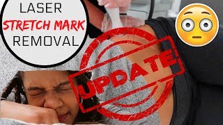 Famous Laser Stretch Mark Removal - UPDATE #1!! Wealth