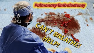 HELP! CAN'T BREATHE RIGHT! - Removing Deadly Blood Clots From The Lungs (Pulmonary Embolectomy)