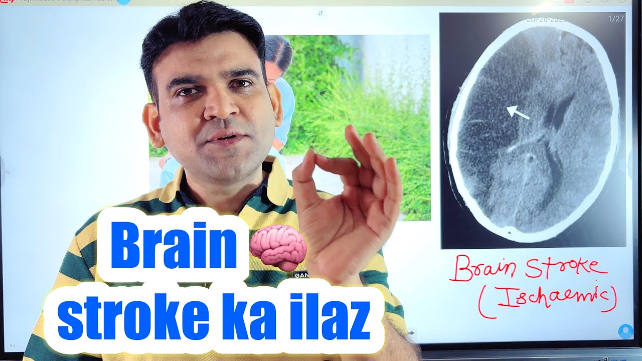 Brain stroke ka ilaz #drniteshraj CVA ischaemic 