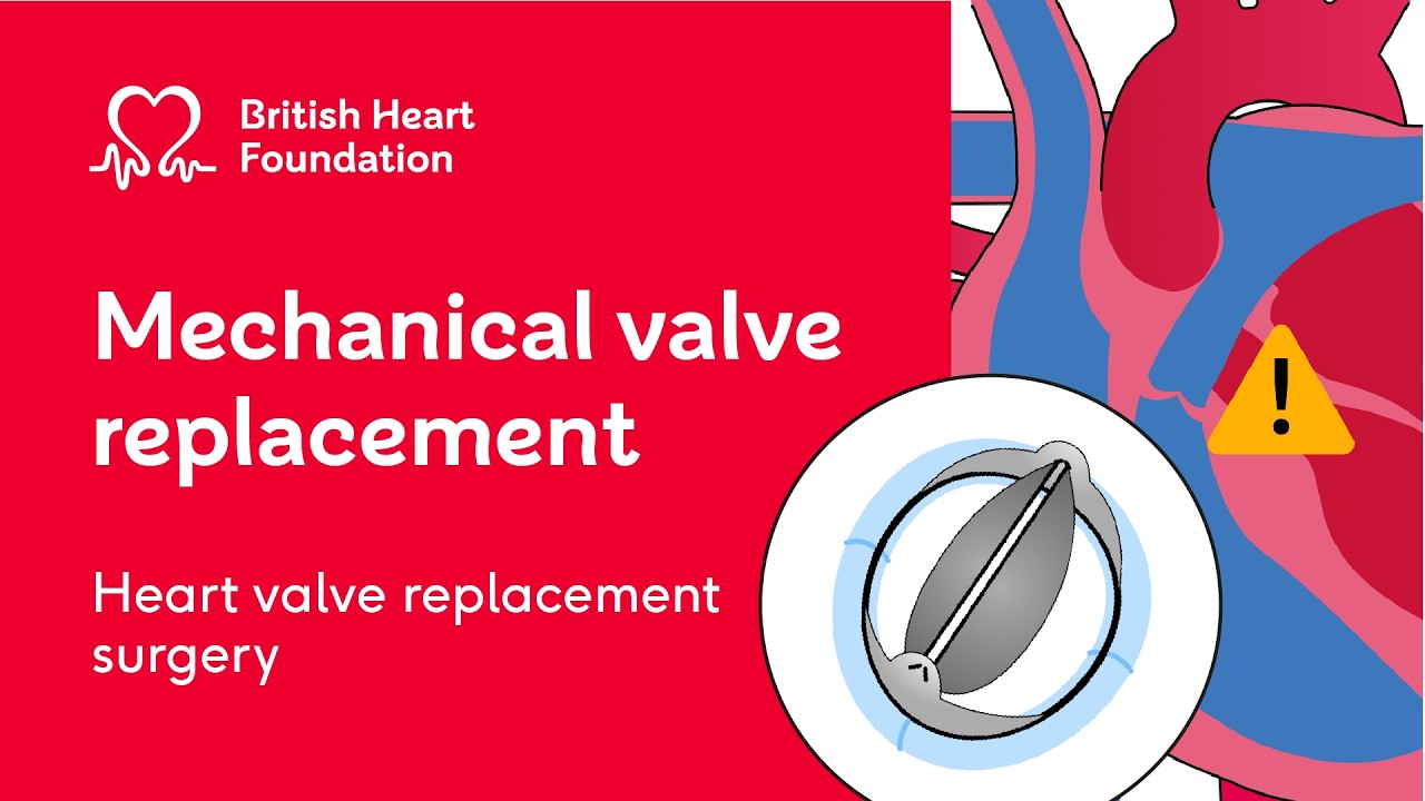 Heart valve replacement: mechanical heart valve – BHF