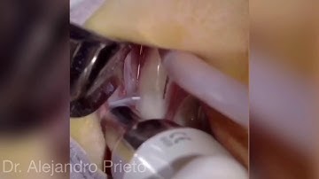 Bone regeneration khoury