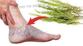 Incredible! Eliminate varicose veins with rosemary. A treasure that should be in every home!