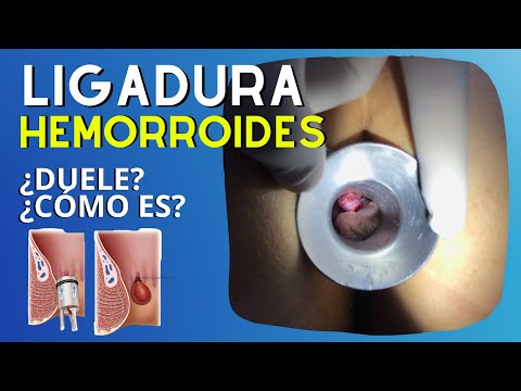 🧶 ¿Qué es la 𝐋𝐈𝐆𝐀𝐃𝐔𝐑𝐀 de Hemorroides, en quién se puede realizar y cómo se hace?