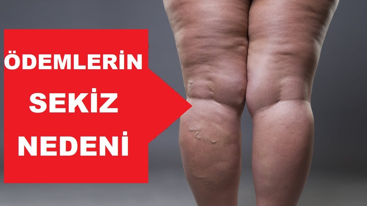 Vücudumuzdaki Ödemlerin Sekiz Nedeni | Dr.Berg Türkçe