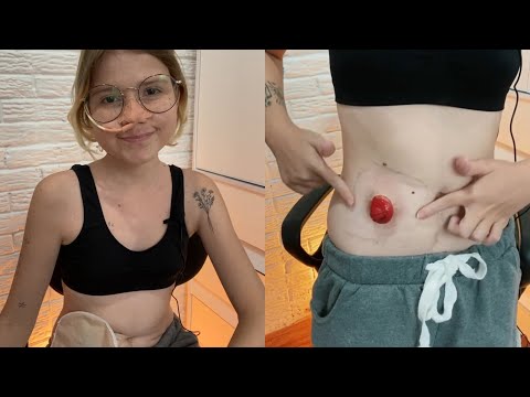 Vídeo: Como trocar uma bolsa de colostomia: 12 etapas (com fotos)