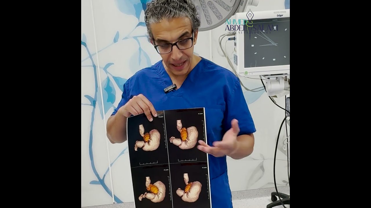 ايه الفرق بين تدبيس المعده القديم والتكميم الحديث وتداعيات كل شيء على صحة المريض ..