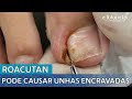 Roacutan pode causar unhas encravadas!