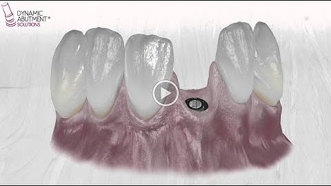 Dynamic Abutment 28º DAS