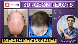 Is it a Hair Transplant? | Reddit Case Study | Reddit Stories | Surgeon Reacts | Reddit Review