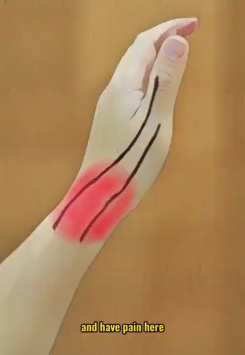 De Quervain's Tenosynovitis: Quick Fix in 5 Steps! #shorts