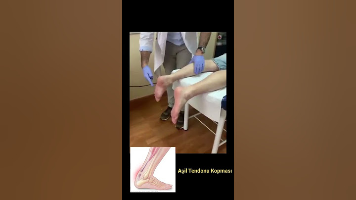 Aşil tendonu rüptürü, Prof.Dr.Serdar Akgün, Serdar Akgün Tıp Videoları