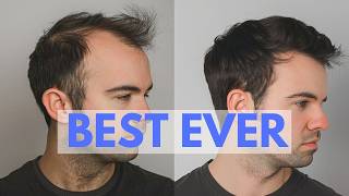 TOP 10 Hair Loss Treatments - Ranked by New Hair Growth