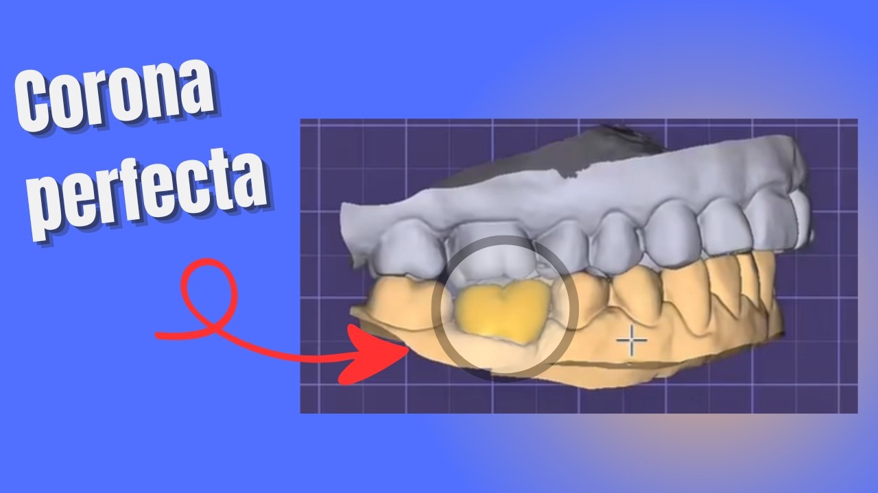 Diseño de una corona paso a paso en Exocad | Workflow completo.
