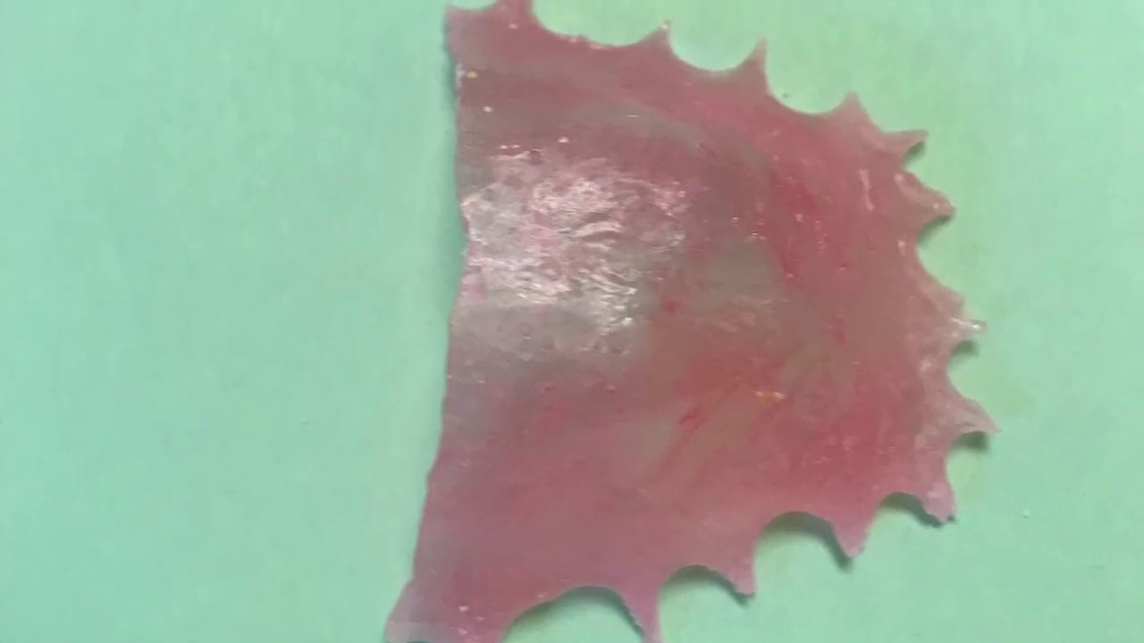 Fabrication Of Palatal Stent YouTube