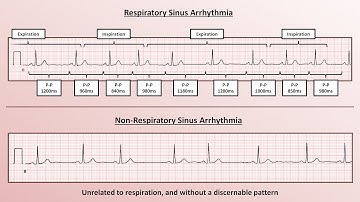 Advanced EKGs - Sinus Node Dysfunction