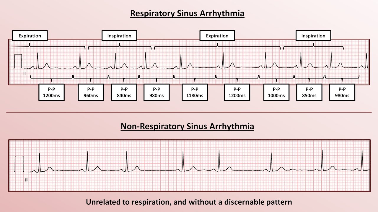 Advanced Ekgs Sinus Node Dysfunction Youtube